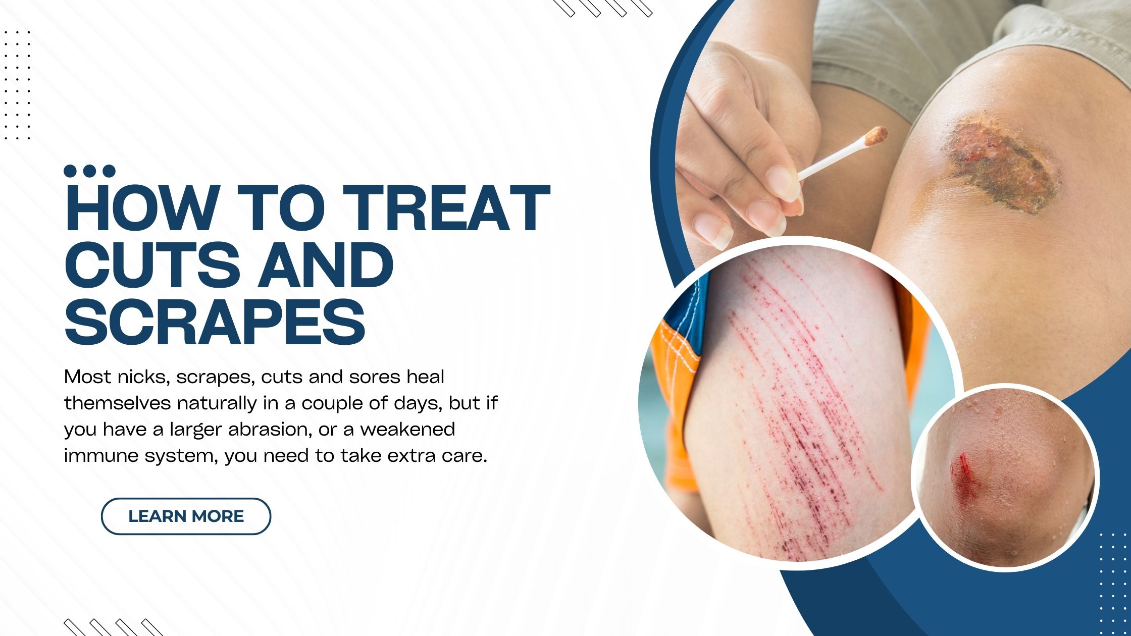 How to Treat Cuts and Scrapes