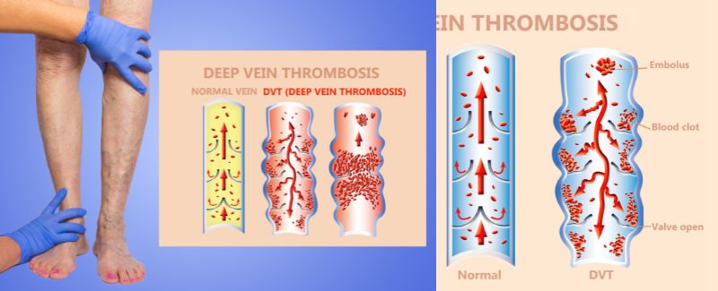 Good News For Thrombosis Prevention