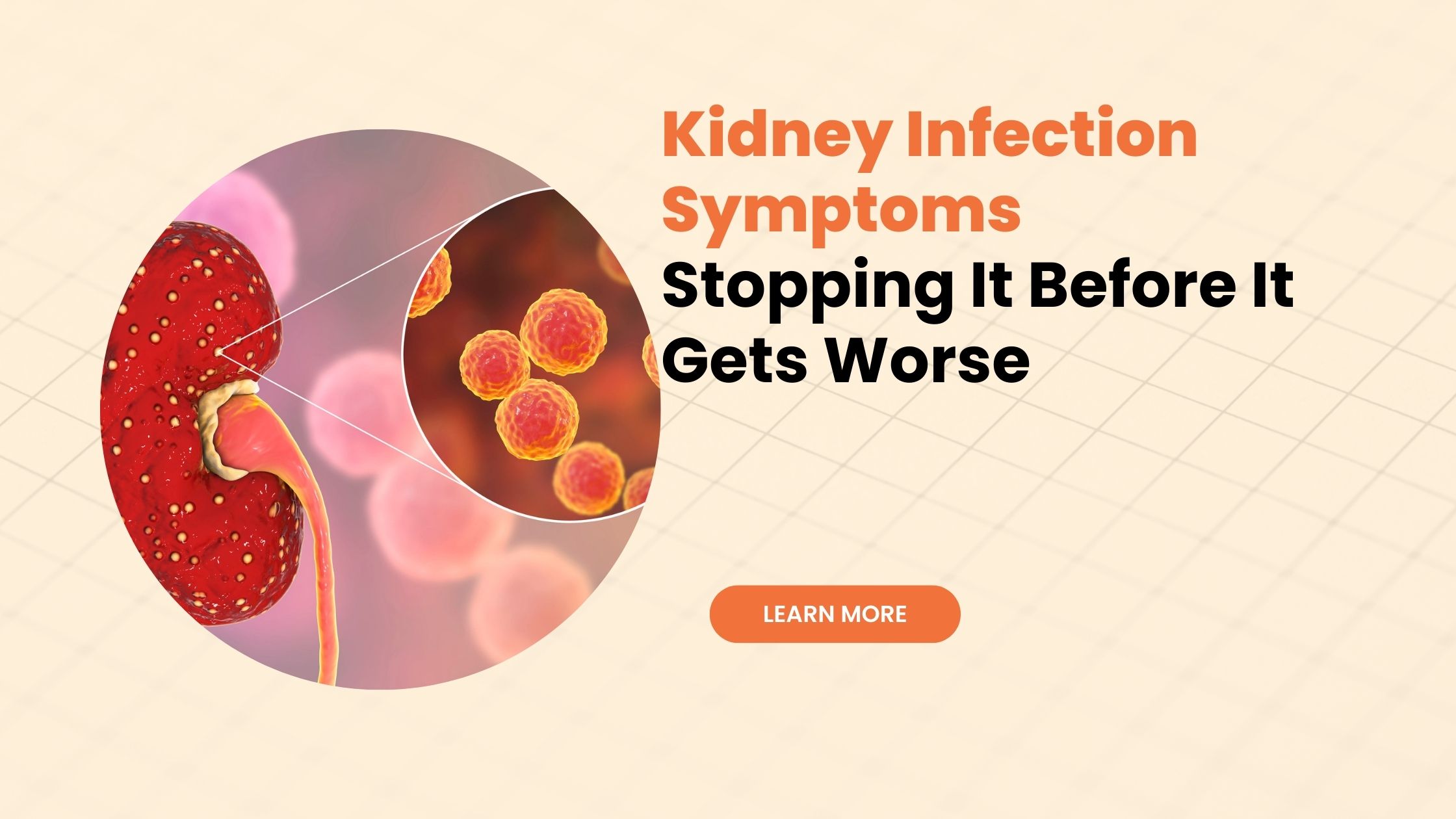 Kidney Infection Symptoms: Stopping It Before It Gets Worse