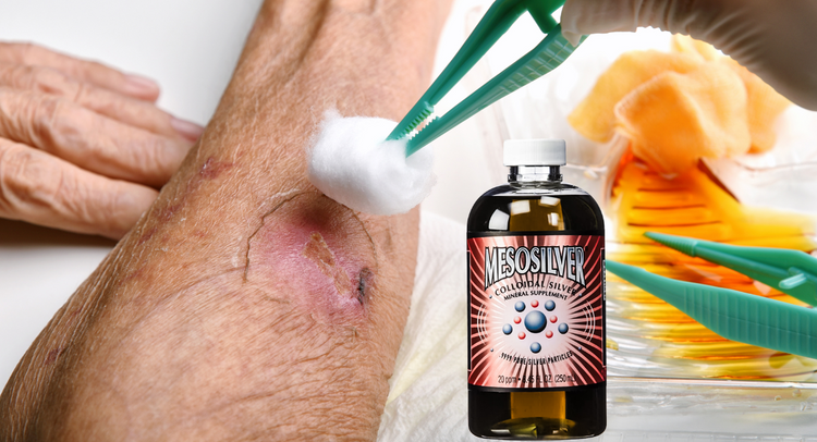 Speed Up Recovery: The Benefits of Colloidal Silver for Burns and Wound ...