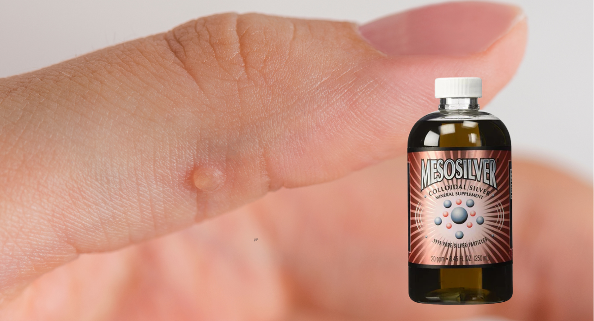 Colloidal Silver for Warts: A Natural Remedy for Skin Health ...