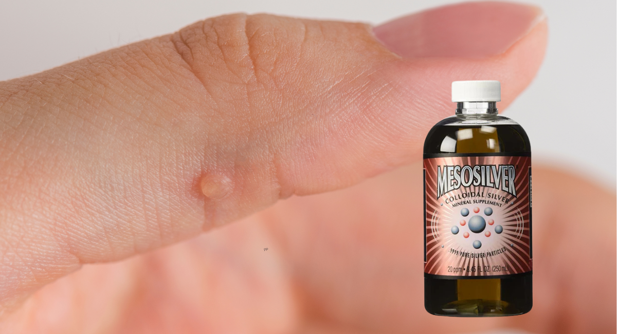 Colloidal Silver for Warts: A Natural Remedy for Skin Health