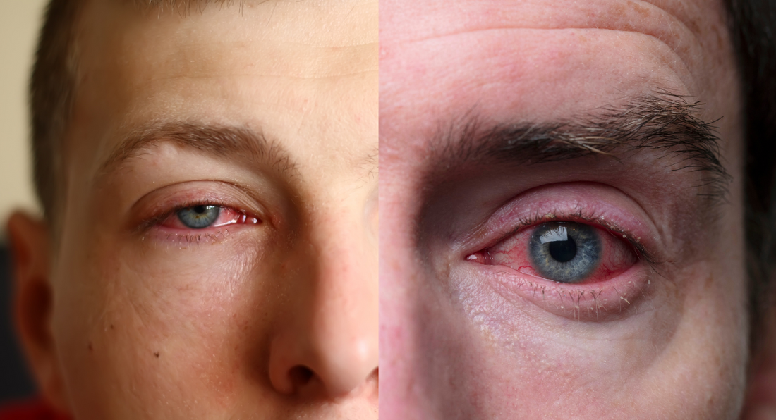 Colloidal Silver for Pink Eye Treatment: A Natural Remedy for Eye Health