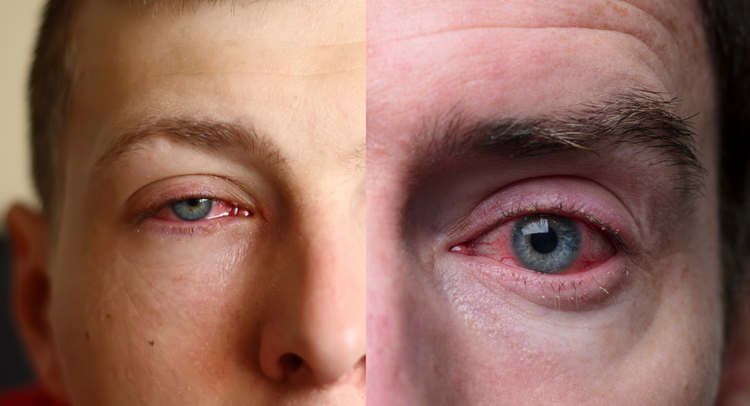 Colloidal Silver for Styes and Pink Eye: A Natural Remedy for Eye ...
