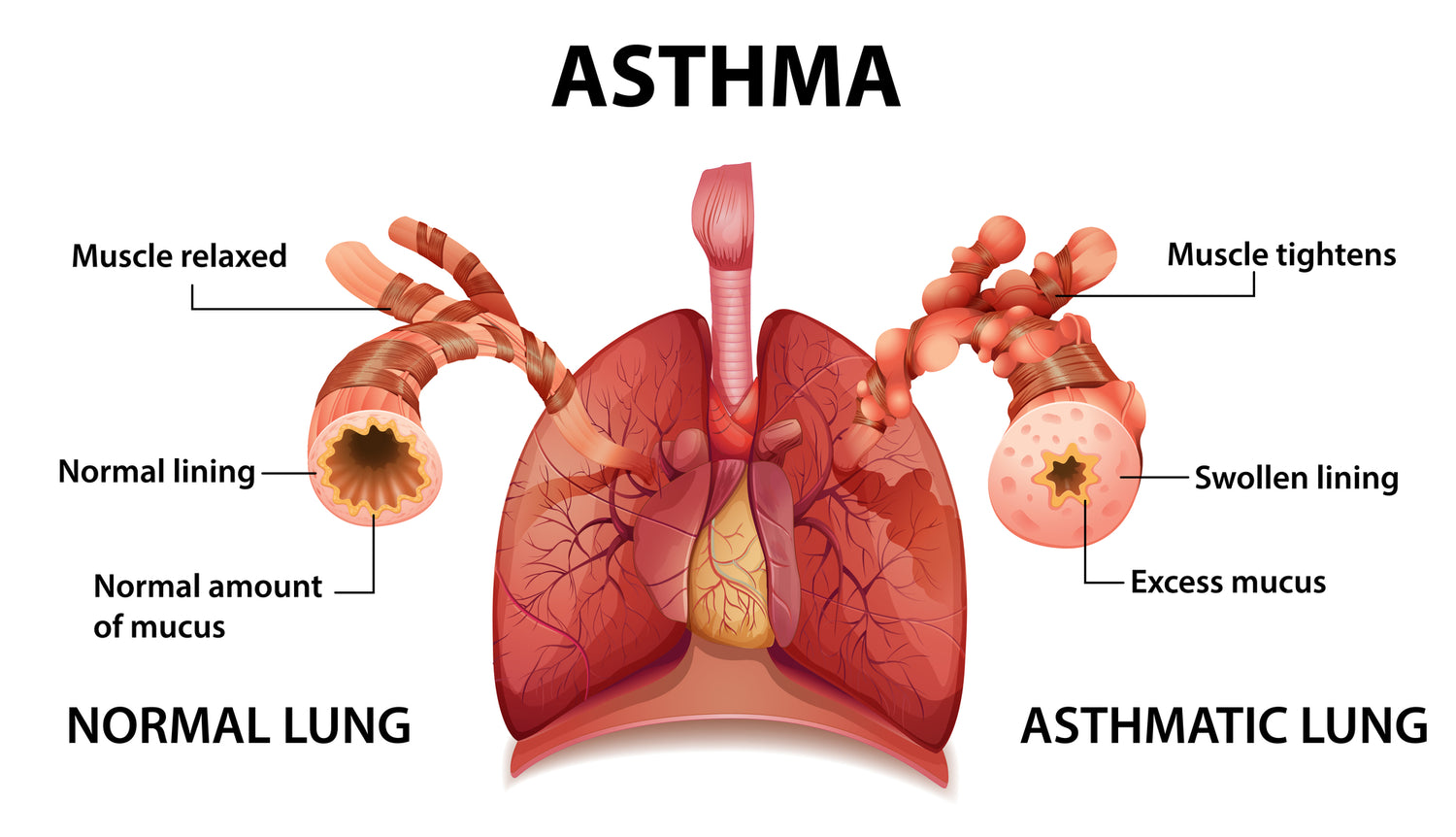 Asthma Symptoms explained