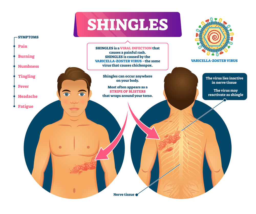 Shingles Infection explained 